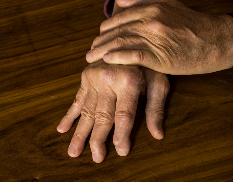 Man-with-psoriatic-arthritis-in-the-hands-receiving-maintenance-care