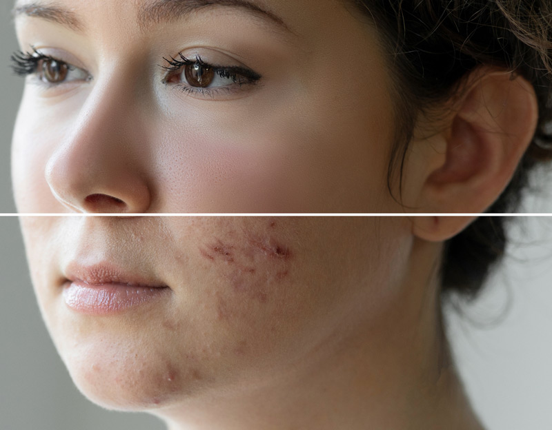 Woman-before-and-after-acne-scar-treatment